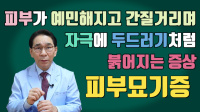 피부묘기증